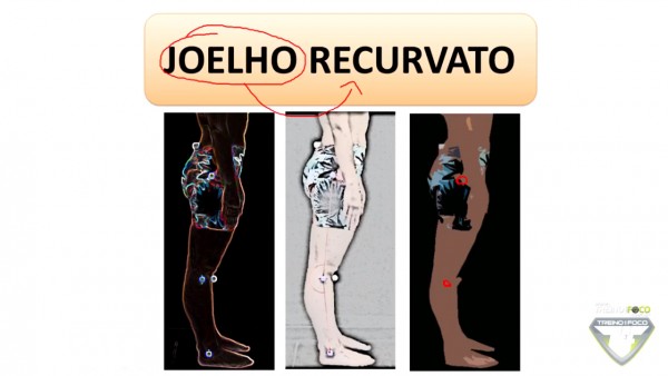 Como Avaliar Joelho Recurvato Utilizando A Biofotogrametria