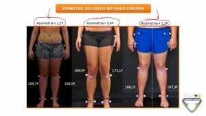 Assimetria De Joelho Como Avaliar Atrav S Da Biofotogrametria