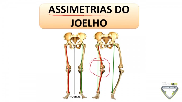 Assimetria De Joelho Como Avaliar Atrav S Da Biofotogrametria