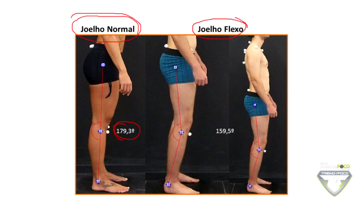 Joelho flexo - Como avaliar com a biotogrametria?