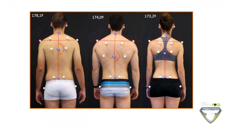 Escoliose Como Identificar Esse Desvio Postural Com Biofotogrametria